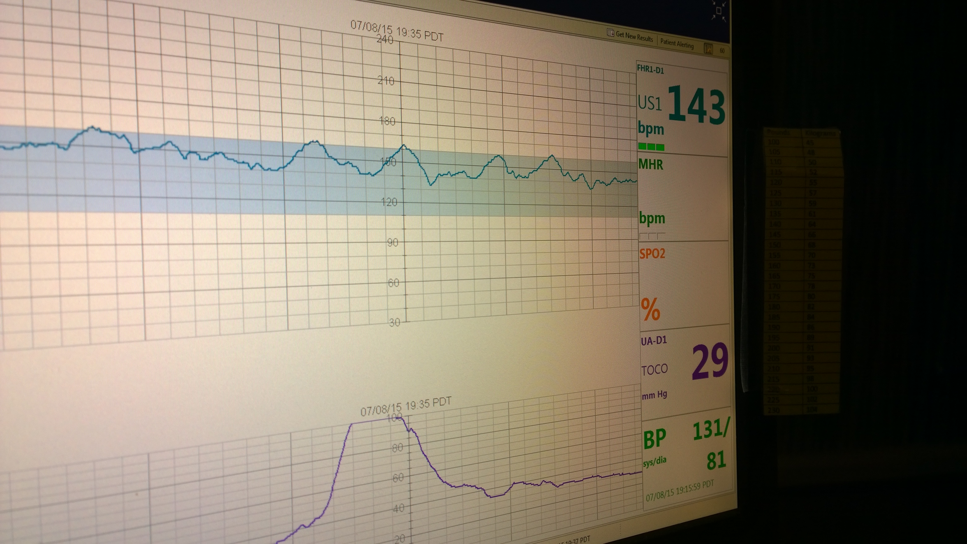 Fetal Monitoring